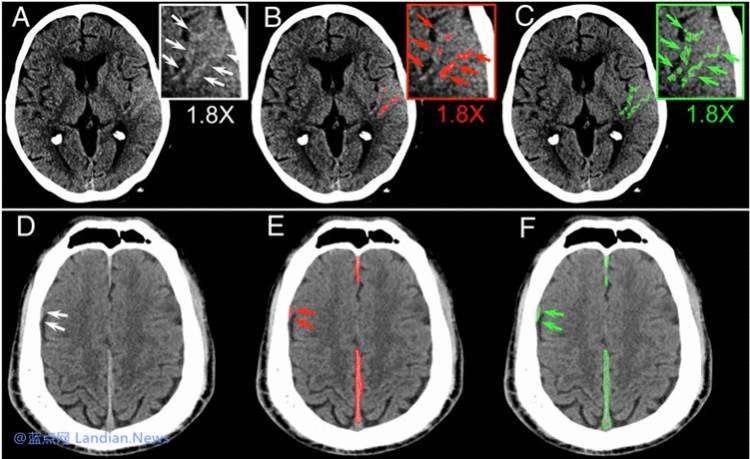 研究人员利用卷积神经网络在检测脑出血方面取得非常卓越的准确率